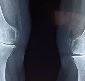 what causes cracking knees