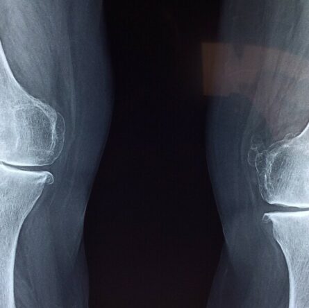 what causes cracking knees