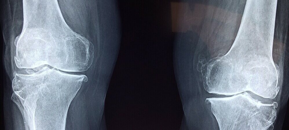 what causes cracking knees